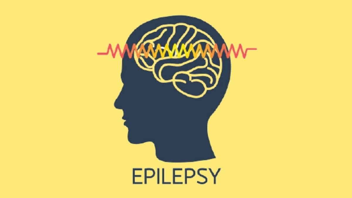 Epilepsy can be diagnosed more accurately with genetic risk scores