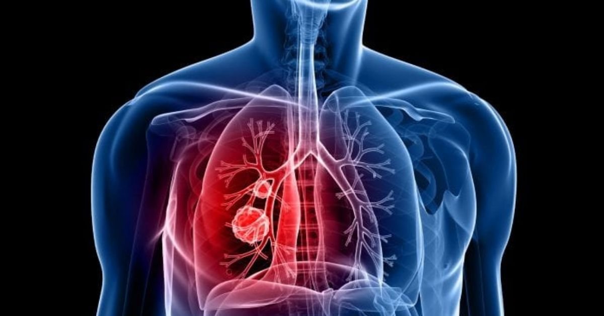 Study reveals how persistent lung illness develops after recovery from COVID-19